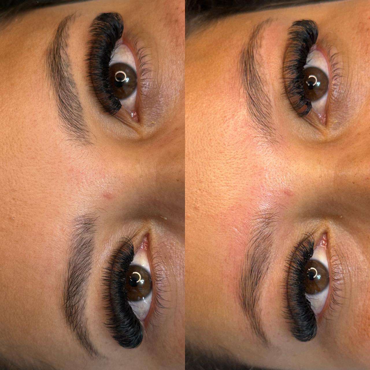 Remoção de Micropigmentação