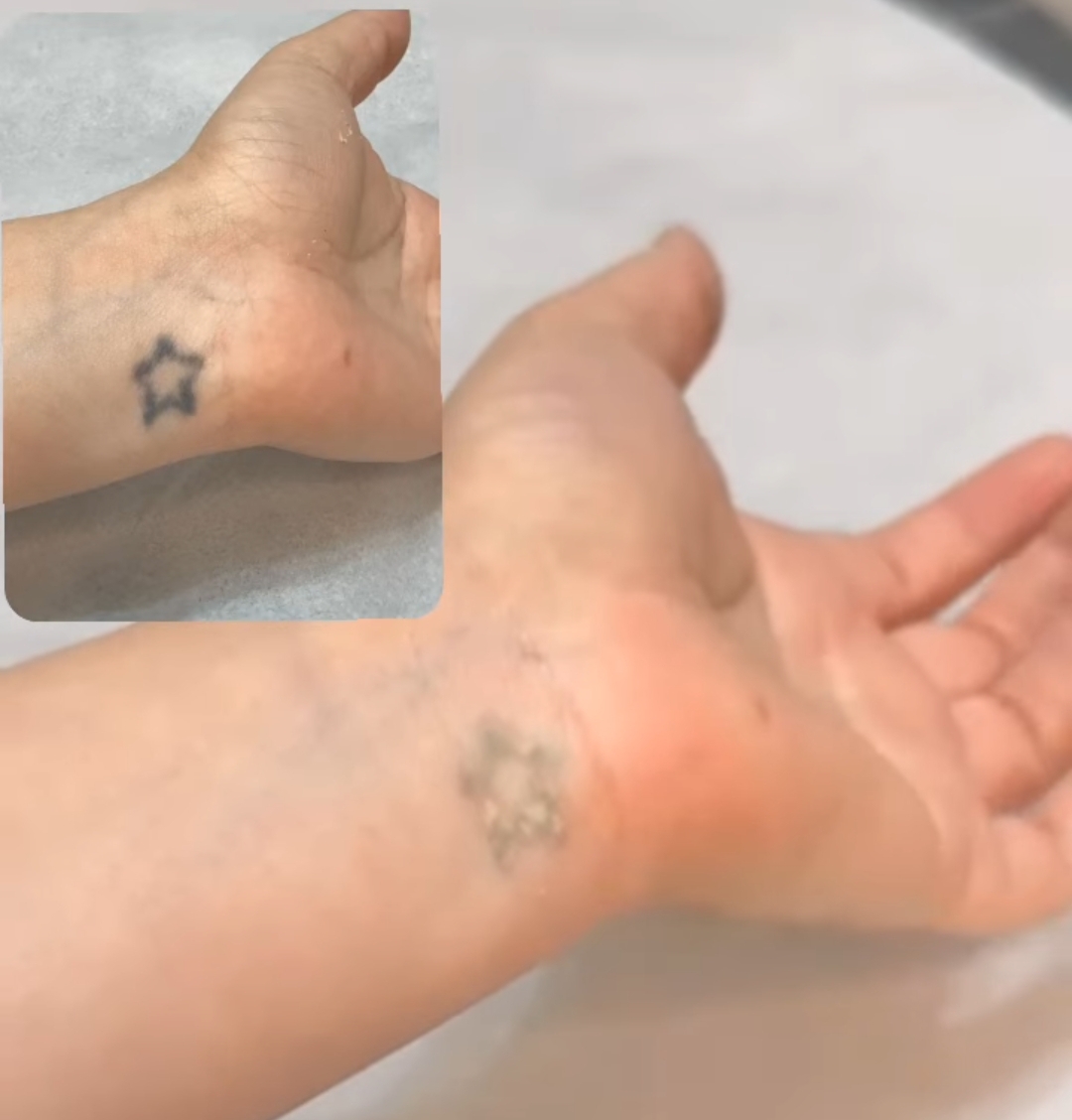Remoção de Tatuagem
