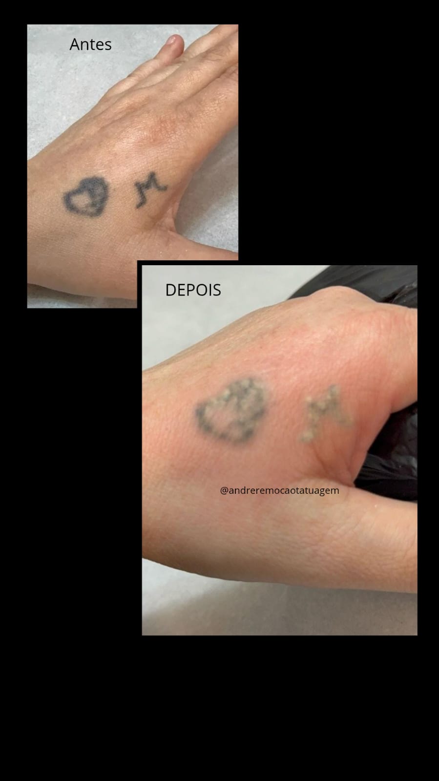 Remoção de Tatuagem