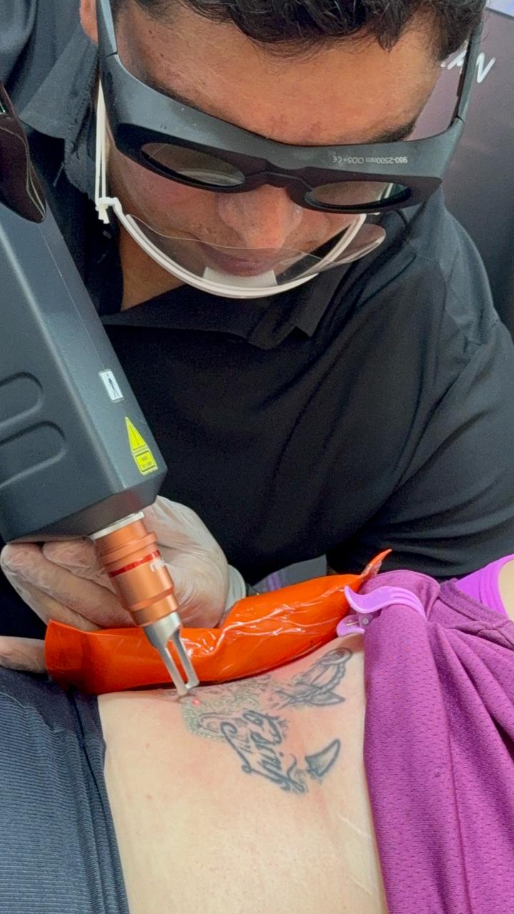 Remoção de Tatuagem