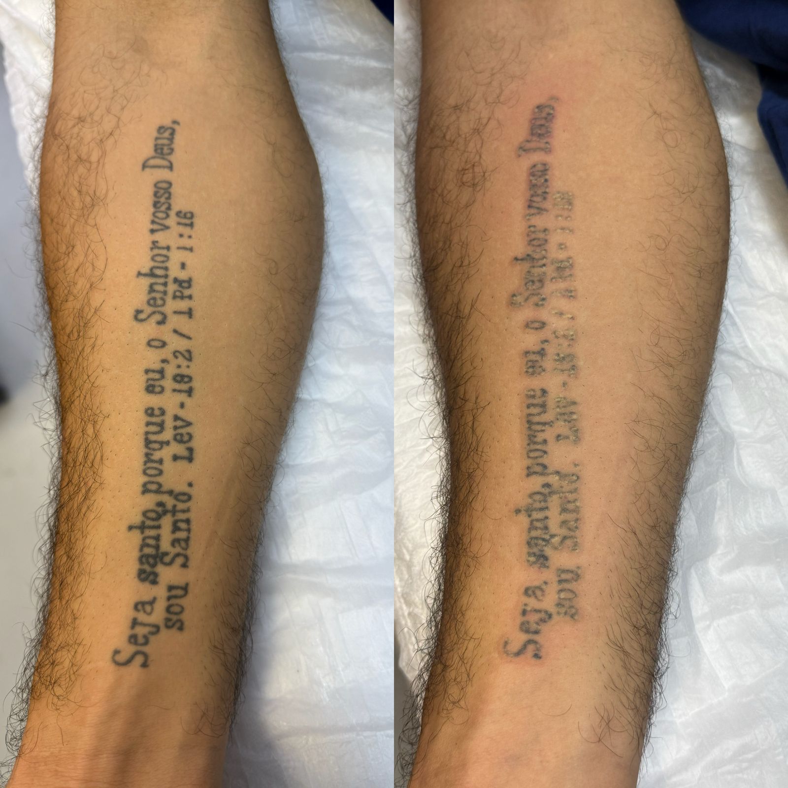 Remoção de Tatuagem